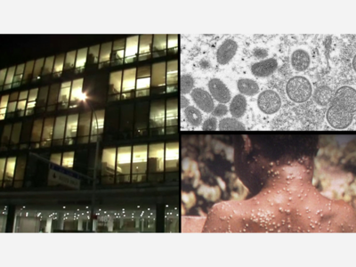 NEW YORK CITY: Health Officials Say Monkeypox Cases Continue To Rise